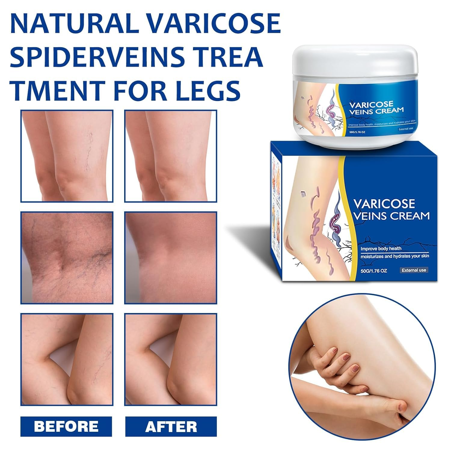 🎉Buy One Get One Free🎁 -Alcuras® Fast‑Absorbing Varicose Veins Care Cream For Smooth, Light, Confident Legs🦵